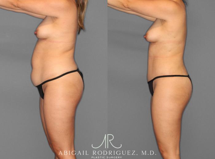 Before & After Tummy Tuck Case 253945 View 3 View in Houston, TX