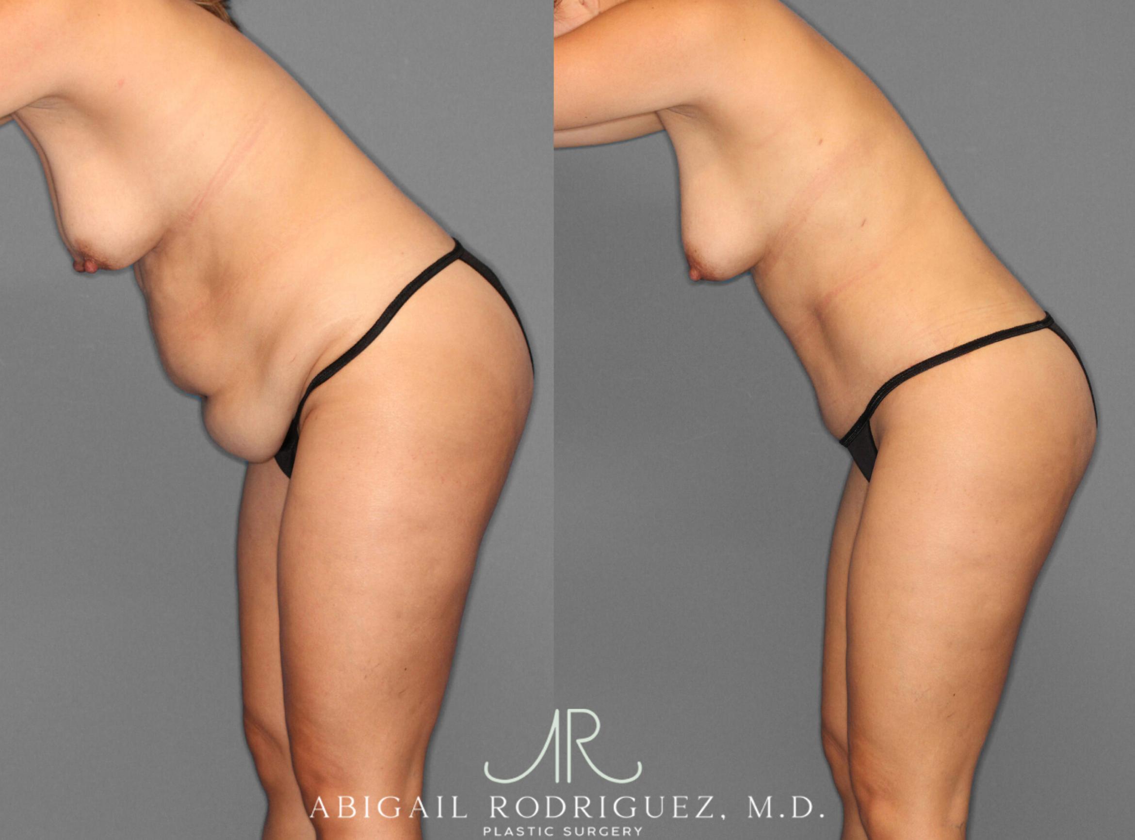 Before & After Tummy Tuck Case 253945 View 4 View in Houston, TX