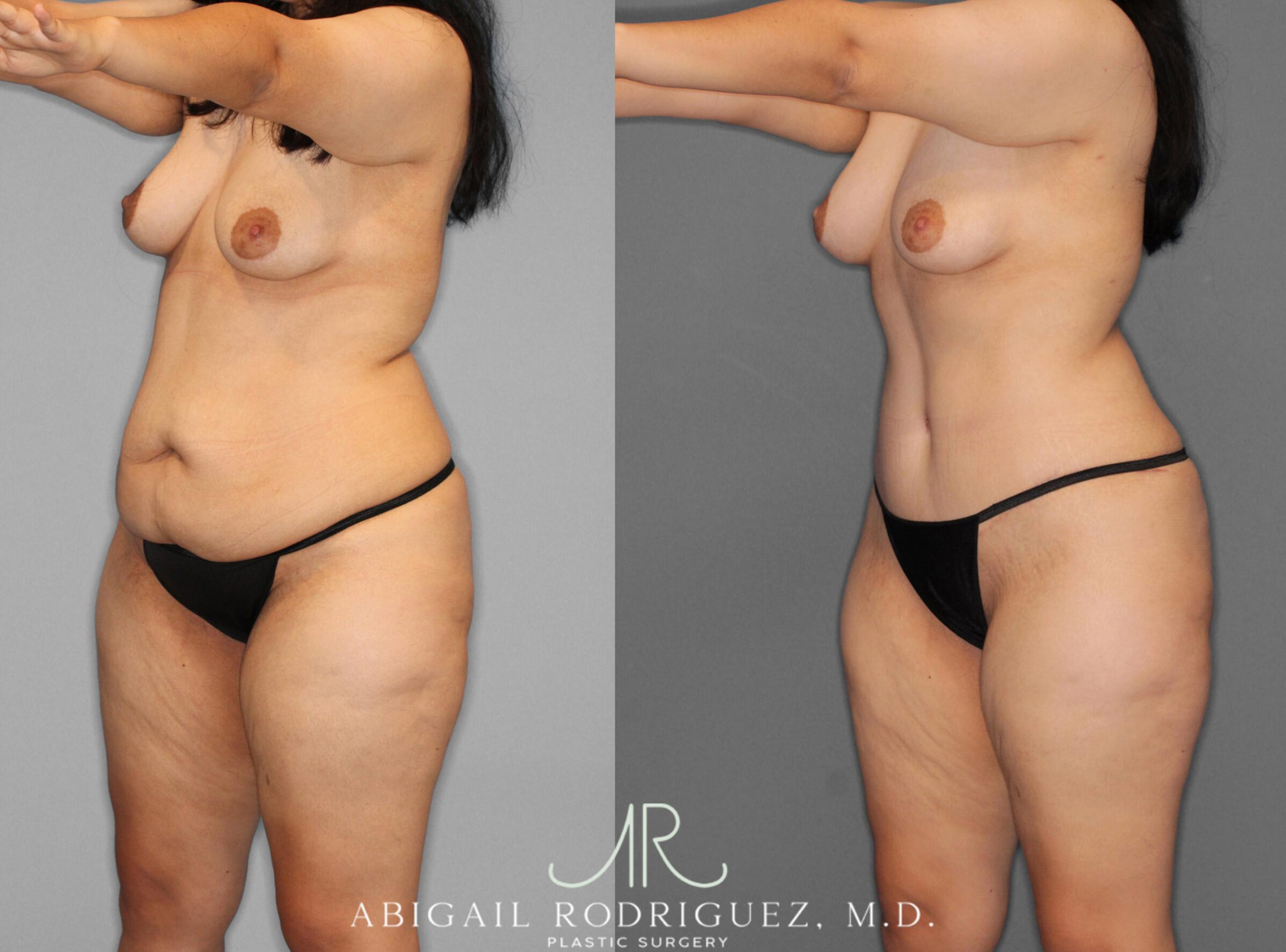Before & After Tummy Tuck Case 253950 View 2 View in Houston, TX