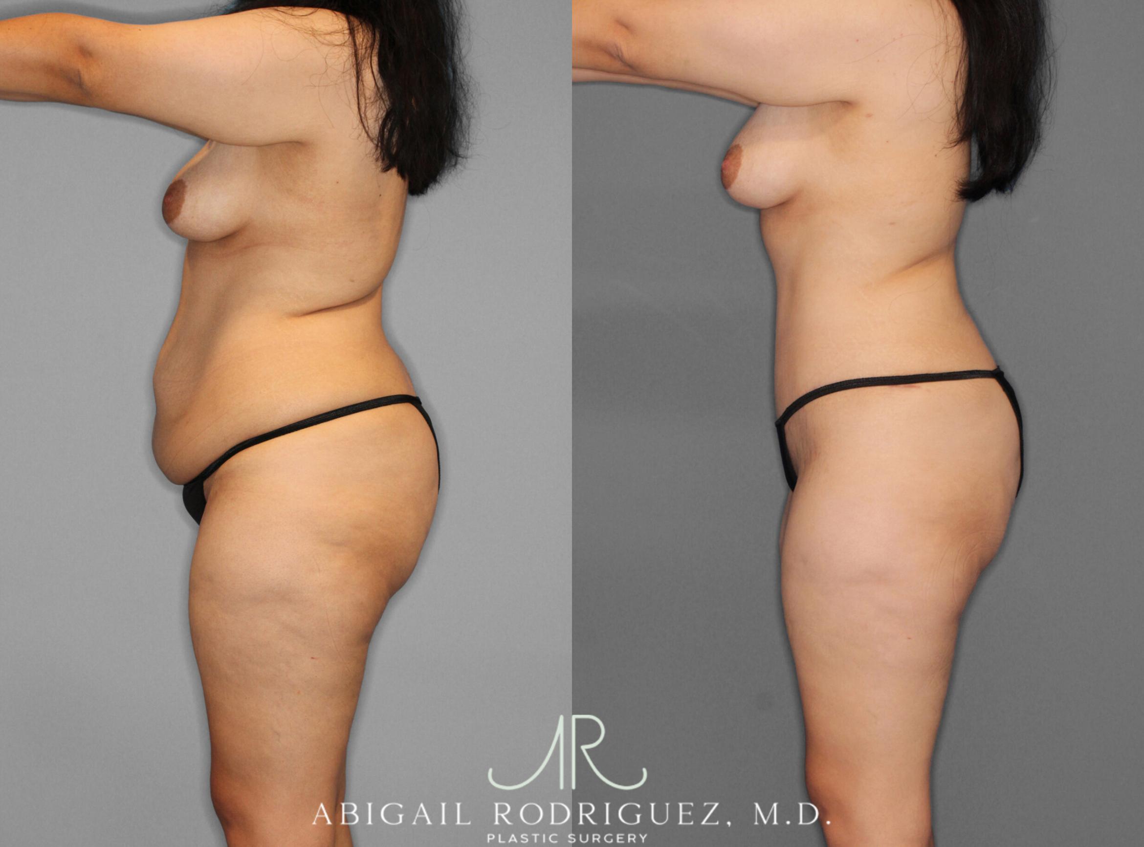Before & After Tummy Tuck Case 253950 View 3 View in Houston, TX