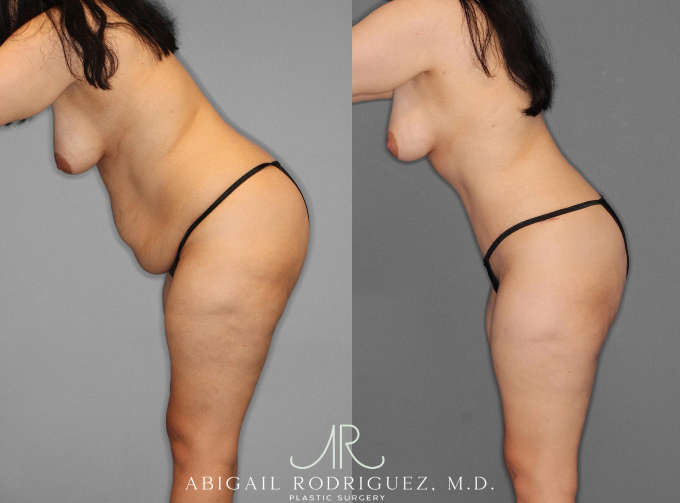 Before & After Tummy Tuck Case 253950 View 4 View in Houston, TX