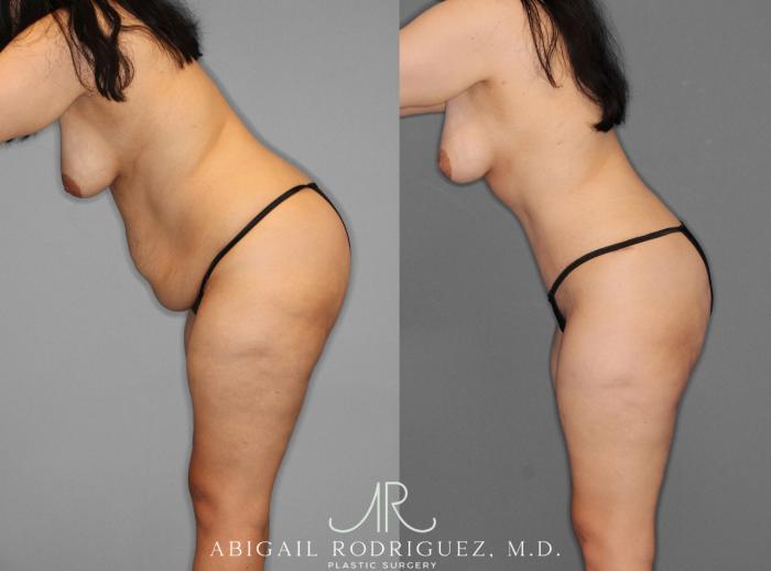 Before & After Tummy Tuck Case 253950 View 4 View in Houston, TX