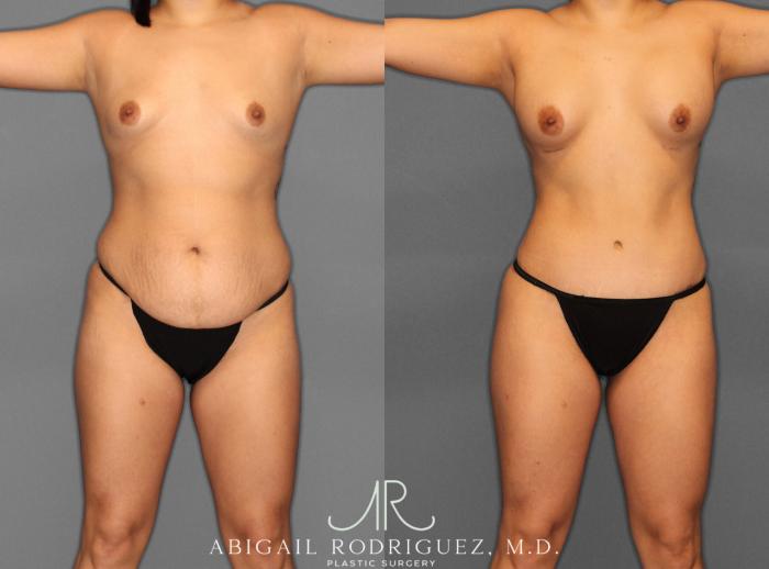 Before & After Tummy Tuck Case 253993 View 1 View in Houston, TX