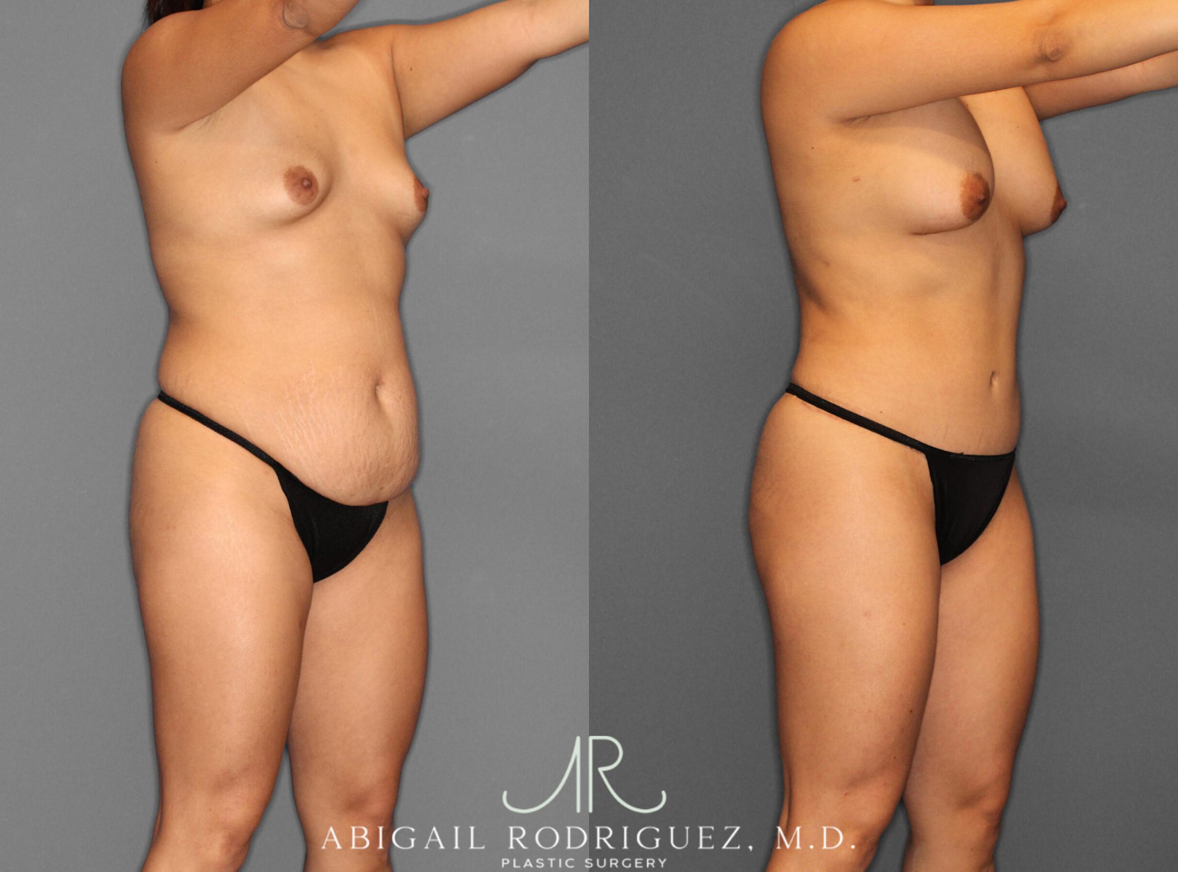 Before & After Tummy Tuck Case 253993 View 2 View in Houston, TX