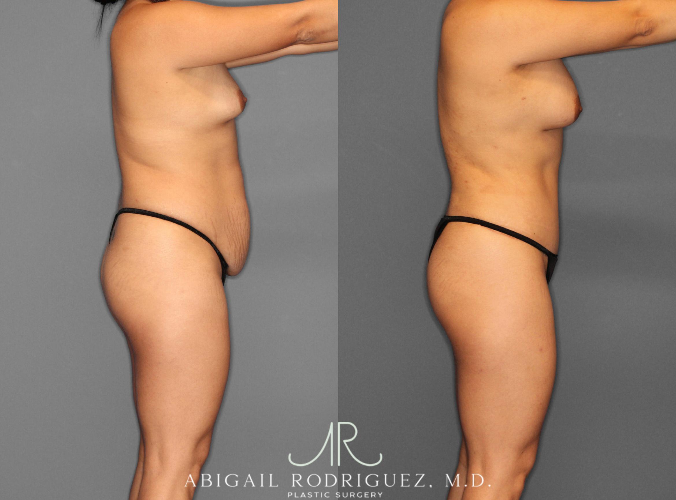 Before & After Tummy Tuck Case 253993 View 3 View in Houston, TX