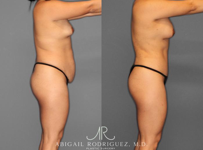 Before & After Tummy Tuck Case 253993 View 3 View in Houston, TX