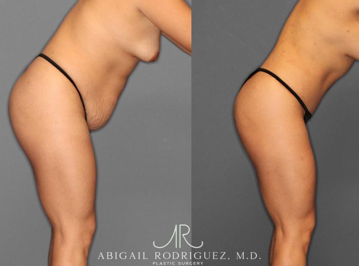 Before & After Tummy Tuck Case 253993 View 4 View in Houston, TX