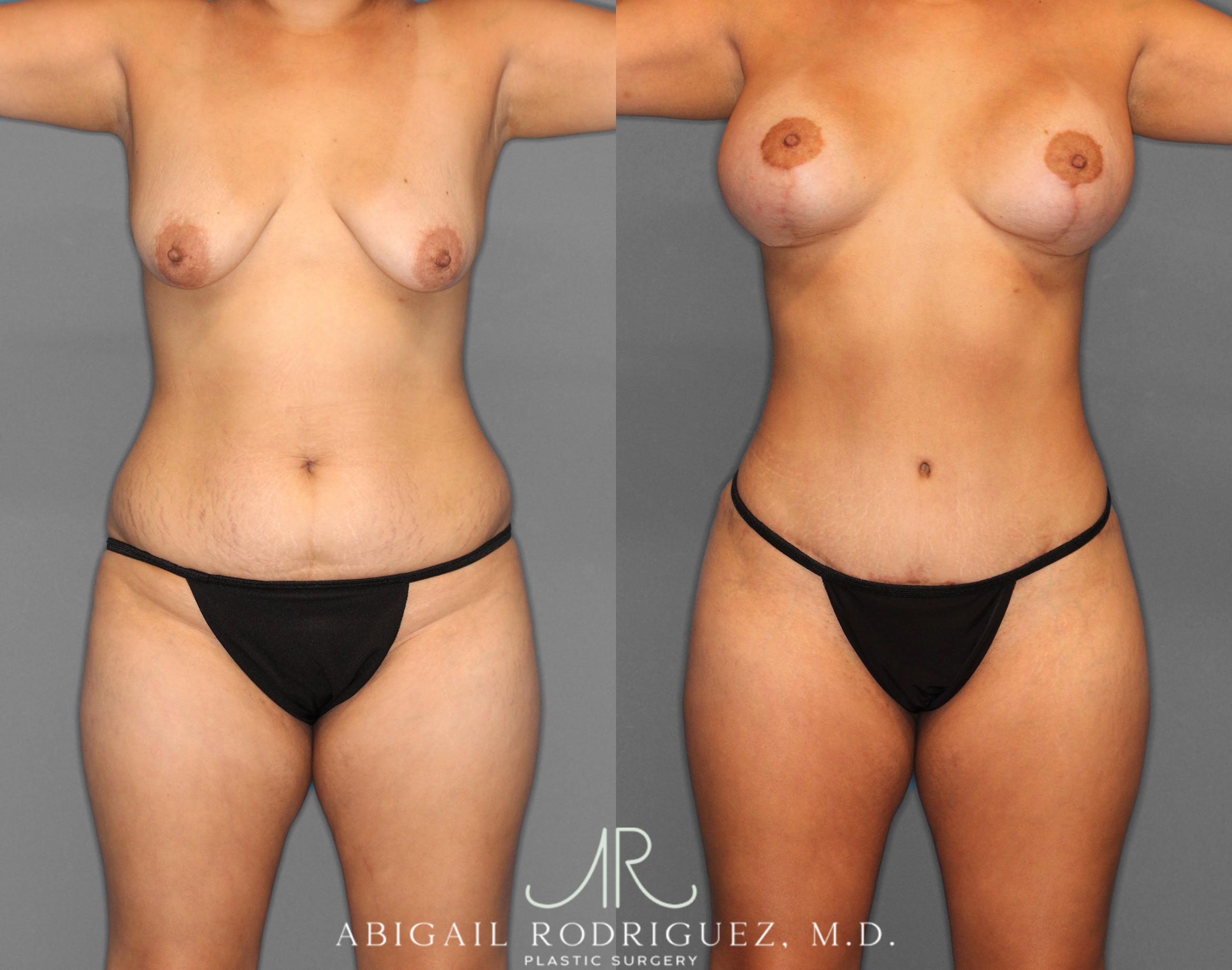 Before & After Tummy Tuck Case 254151 View 1 View in Houston, TX