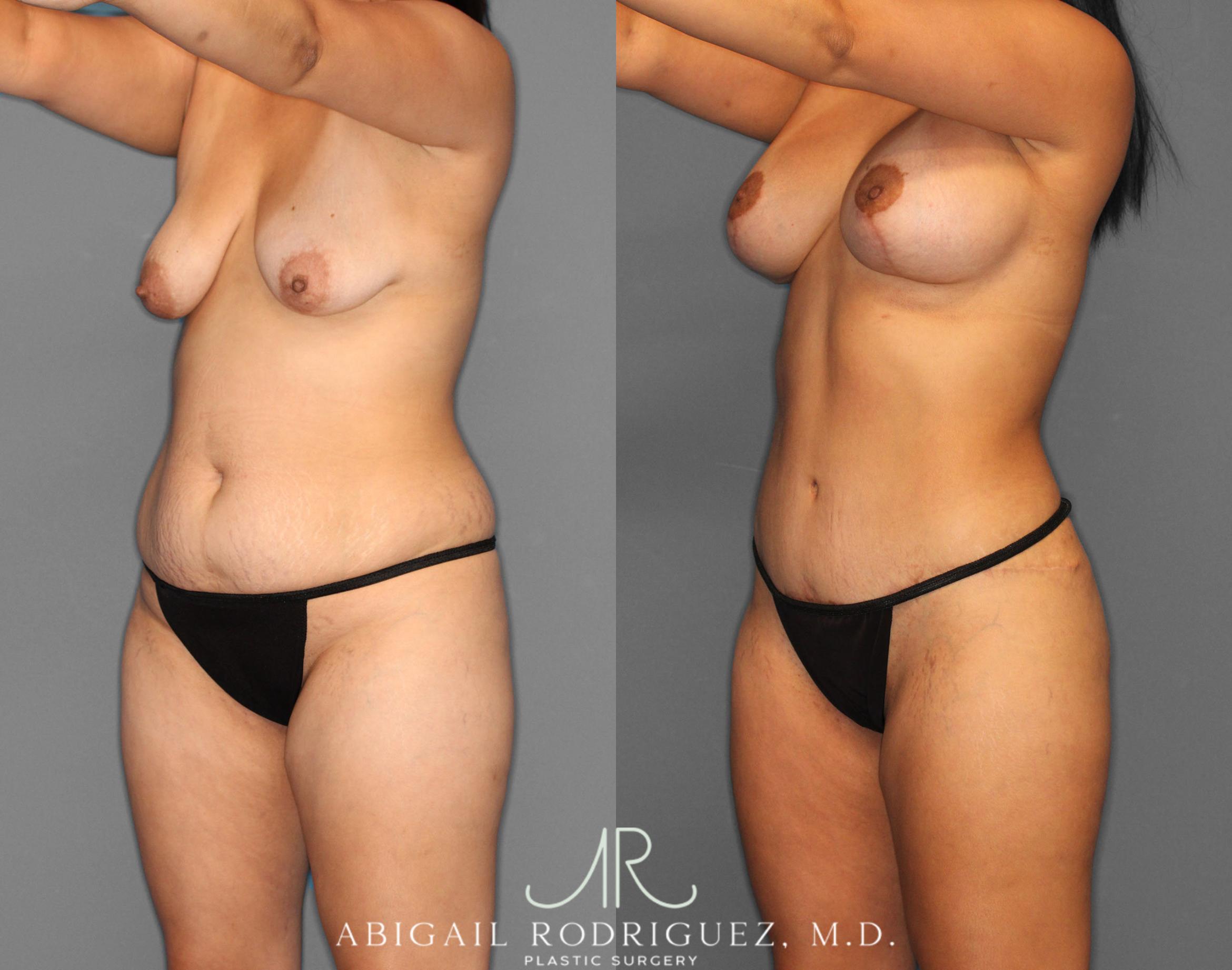 Before & After Tummy Tuck Case 254151 View 2 View in Houston, TX