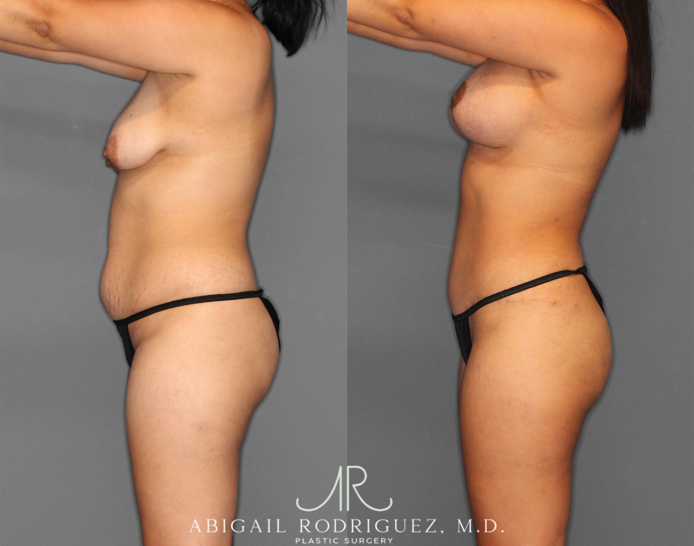 Before & After Tummy Tuck Case 254151 View 3 View in Houston, TX
