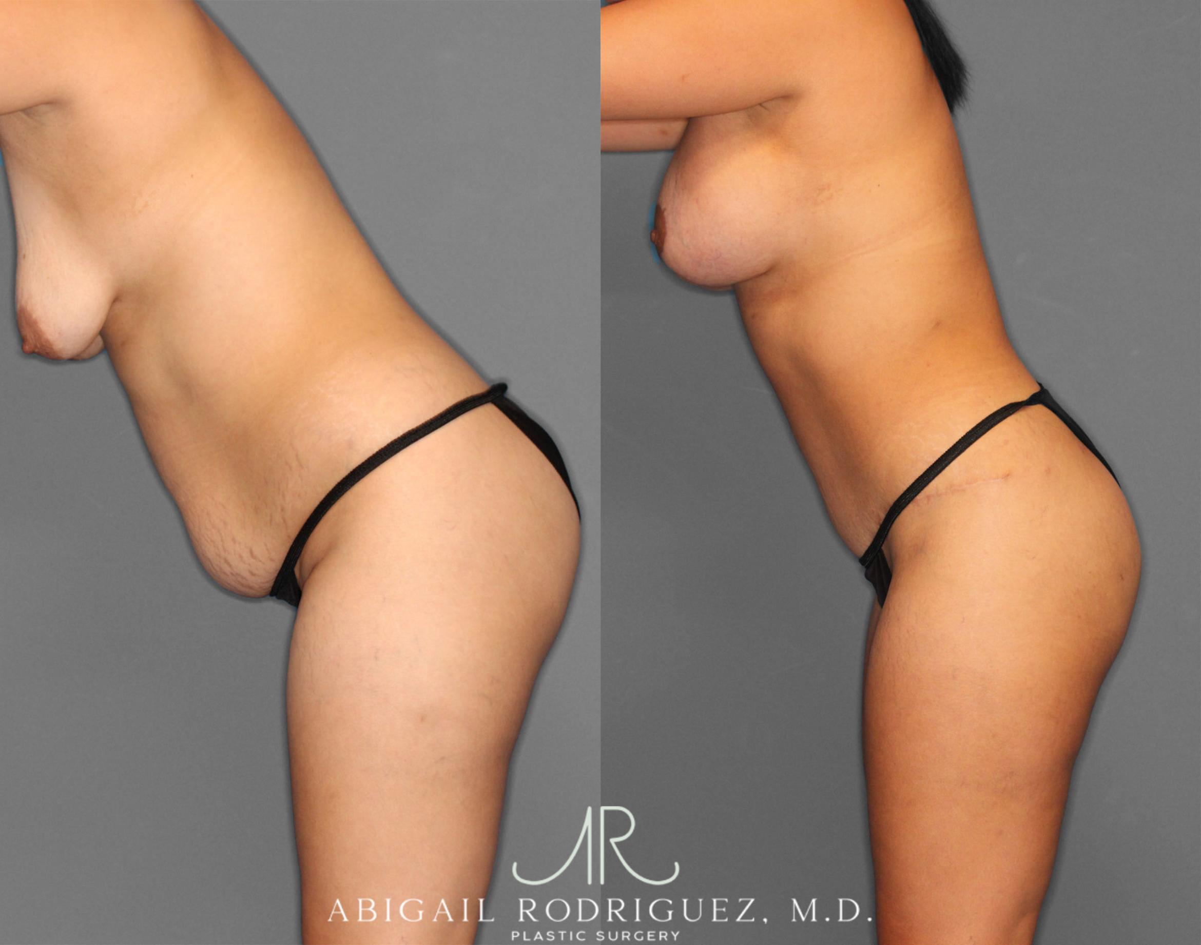 Before & After Tummy Tuck Case 254151 View 4 View in Houston, TX