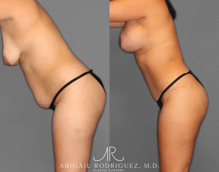 Before & After Tummy Tuck Case 254151 View 4 View in Houston, TX