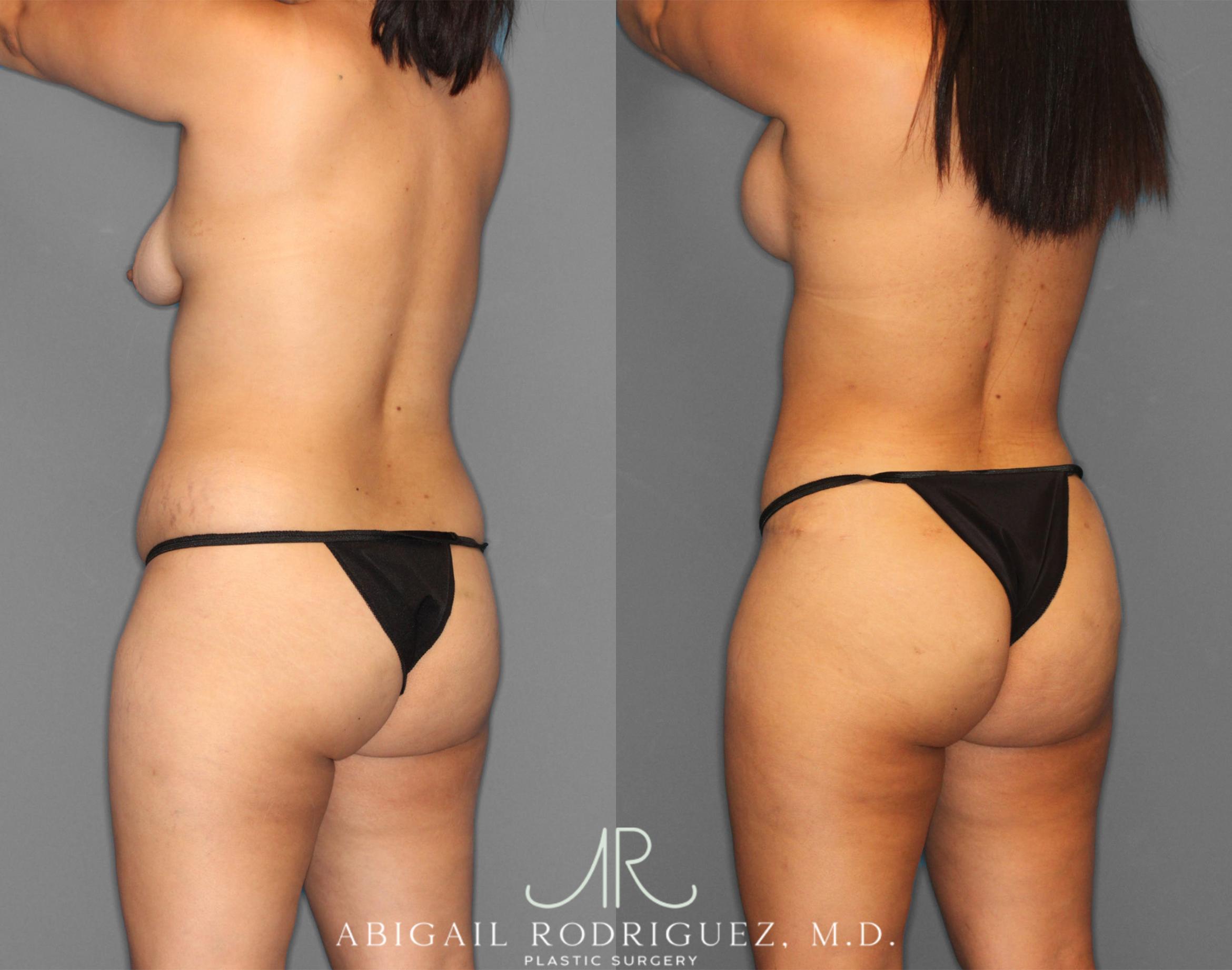 Before & After Tummy Tuck Case 254151 View 5 View in Houston, TX