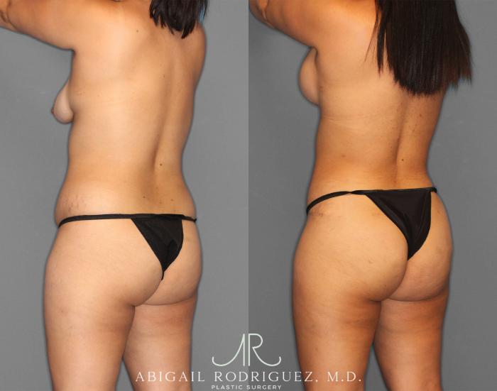 Before & After Tummy Tuck Case 254151 View 5 View in Houston, TX