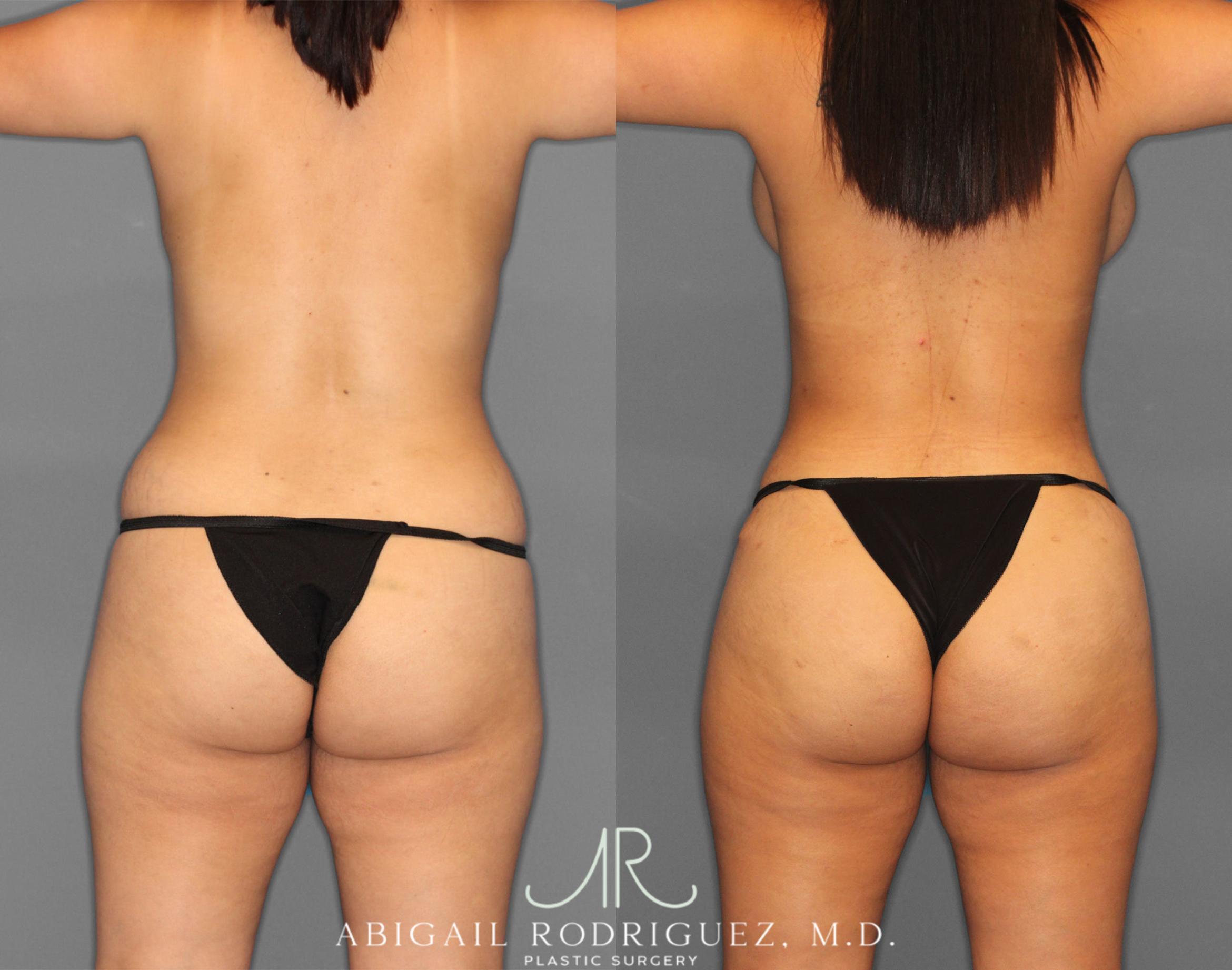 Before & After Tummy Tuck Case 254151 View 6 View in Houston, TX