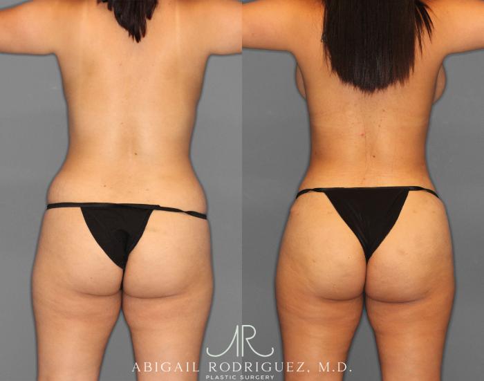 Before & After Tummy Tuck Case 254151 View 6 View in Houston, TX