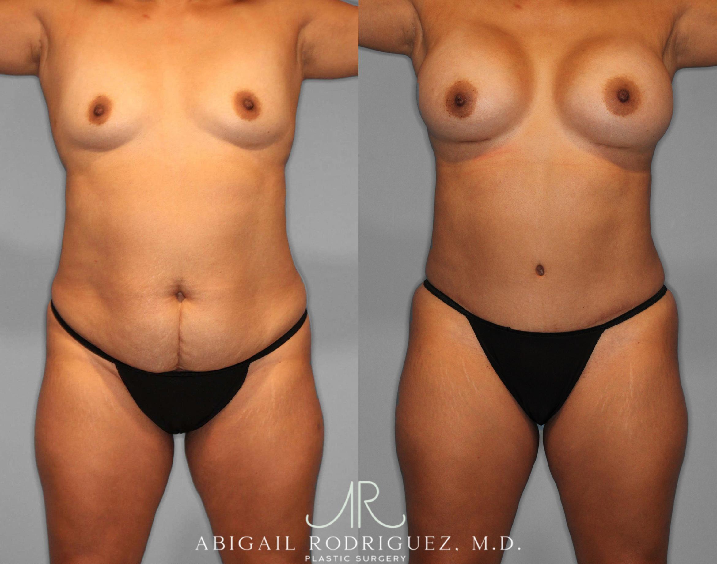 Before & After Tummy Tuck Case 254187 View 1 View in Houston, TX