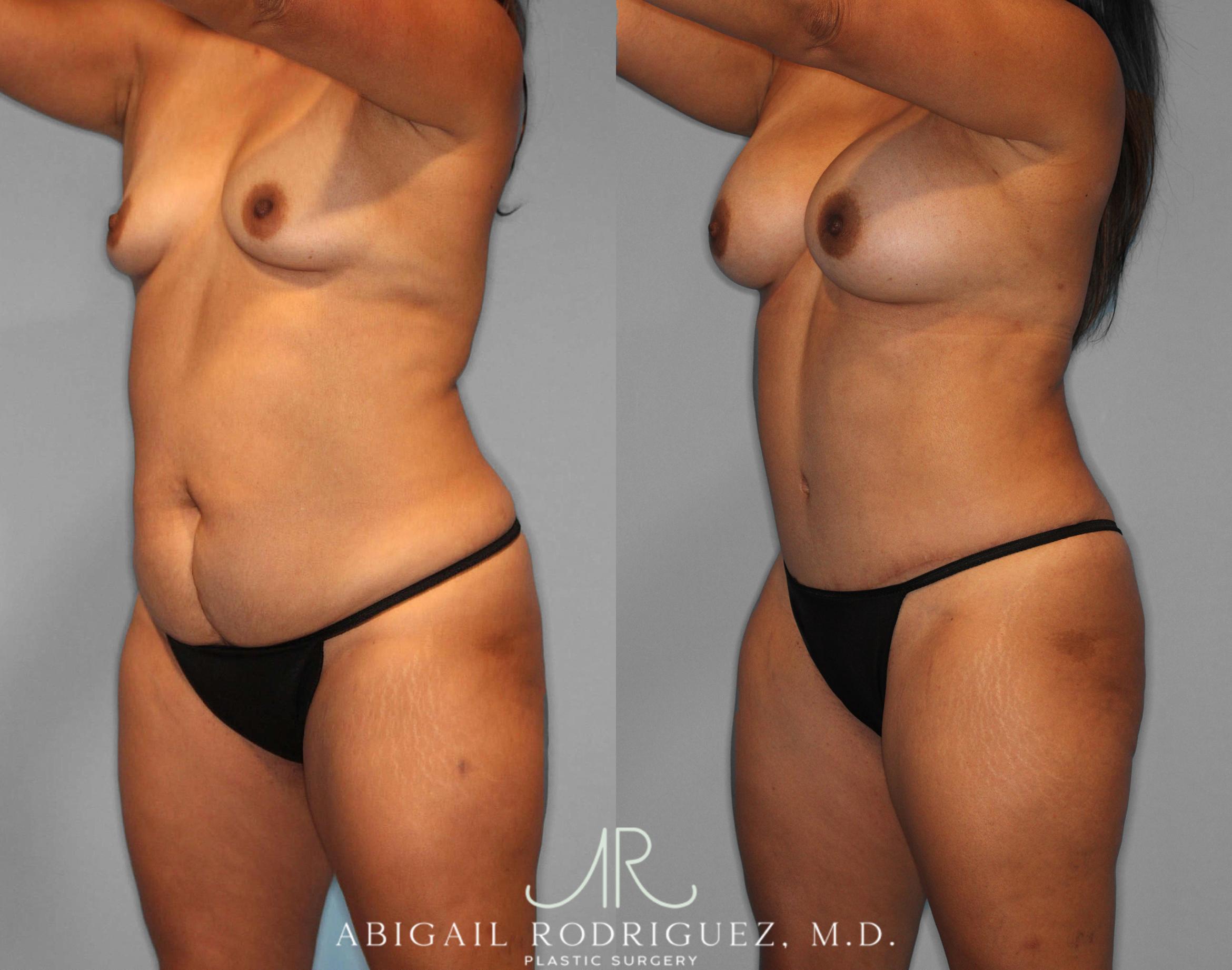 Before & After Tummy Tuck Case 254187 View 2 View in Houston, TX