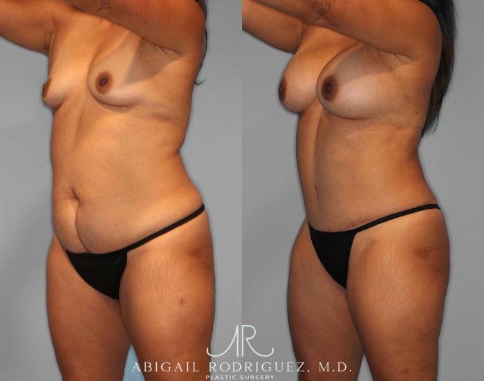 Before & After Tummy Tuck Case 254187 View 2 View in Houston, TX