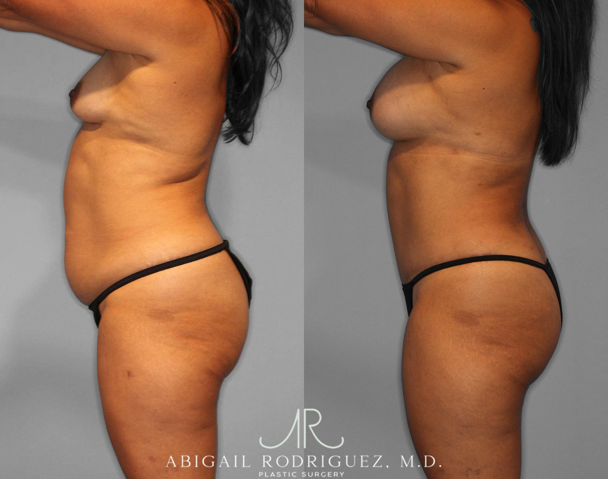 Before & After Tummy Tuck Case 254187 View 3 View in Houston, TX