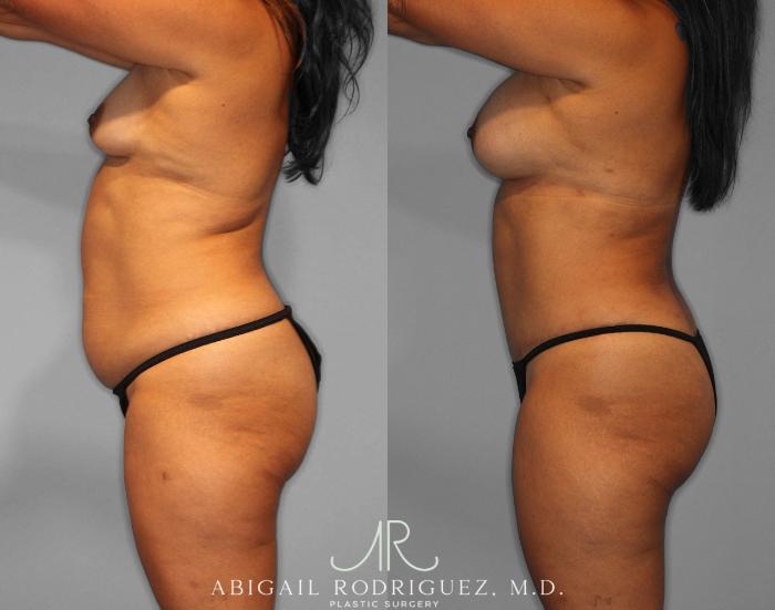 Before & After Tummy Tuck Case 254187 View 3 View in Houston, TX