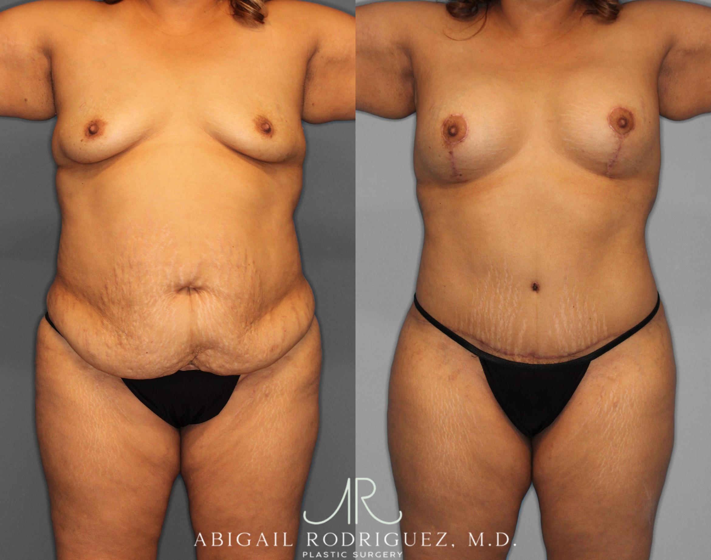 Before & After Tummy Tuck Case 254519 View 1 View in Houston, TX