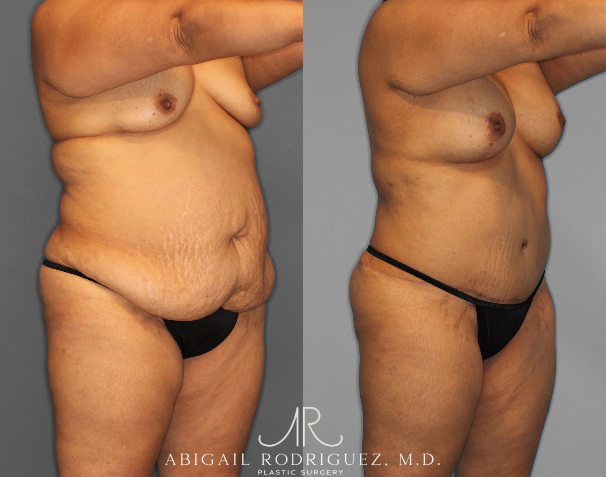 Before & After Tummy Tuck Case 254519 View 2 View in Houston, TX