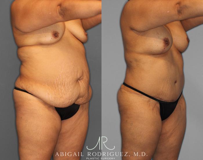 Before & After Tummy Tuck Case 254519 View 2 View in Houston, TX
