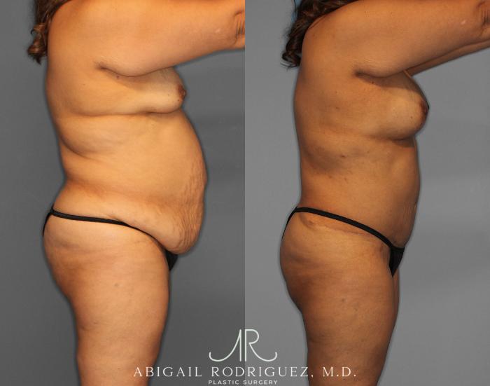 Before & After Tummy Tuck Case 254519 View 3 View in Houston, TX