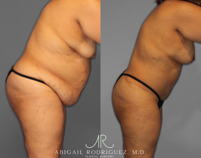 Before & After Tummy Tuck Case 254519 View 4 View in Houston, TX