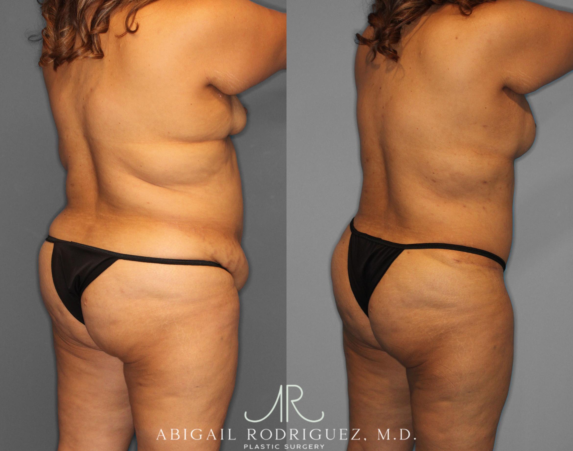 Before & After Tummy Tuck Case 254519 View 5 View in Houston, TX