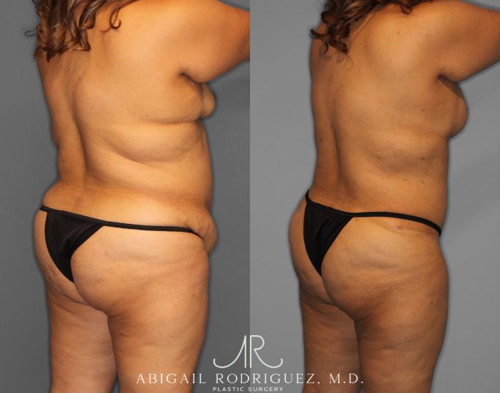 Before & After Tummy Tuck Case 254519 View 5 View in Houston, TX