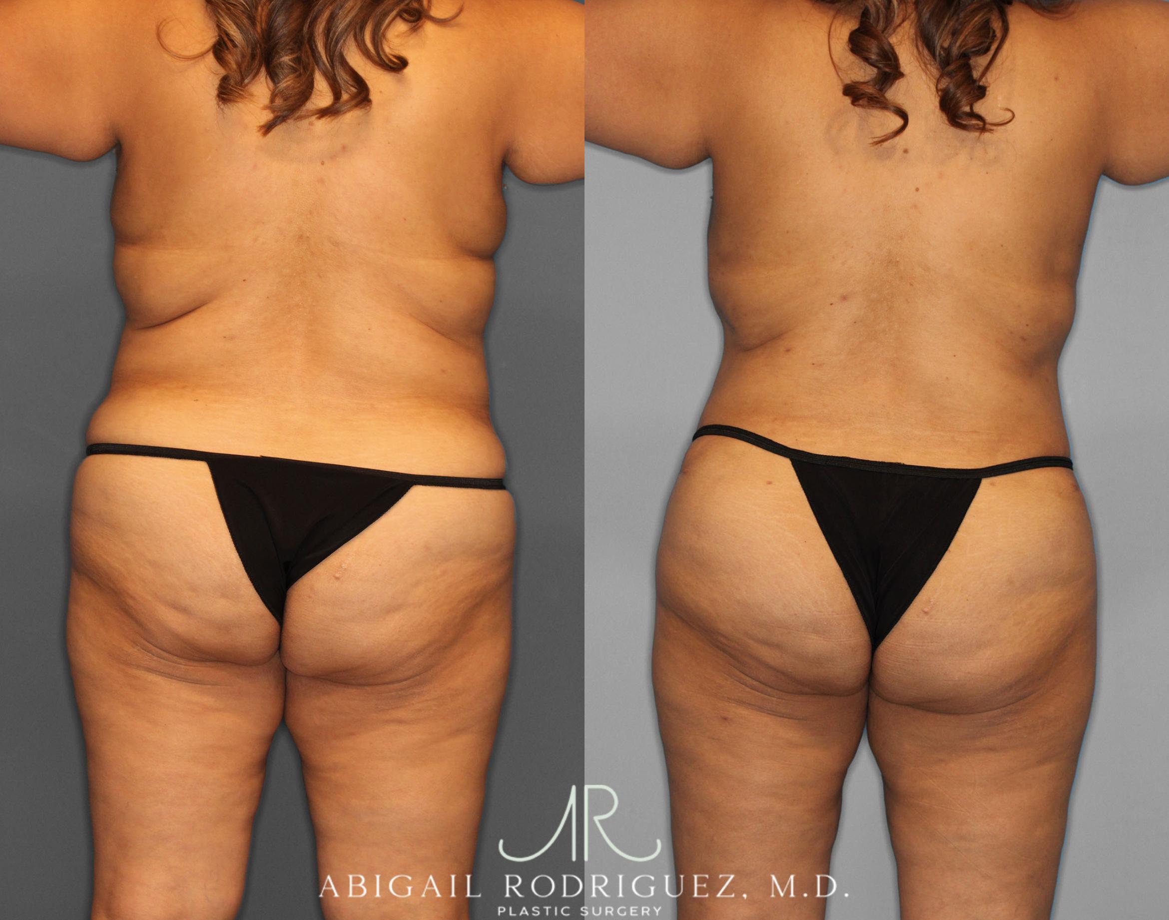 Before & After Tummy Tuck Case 254519 View 6 View in Houston, TX