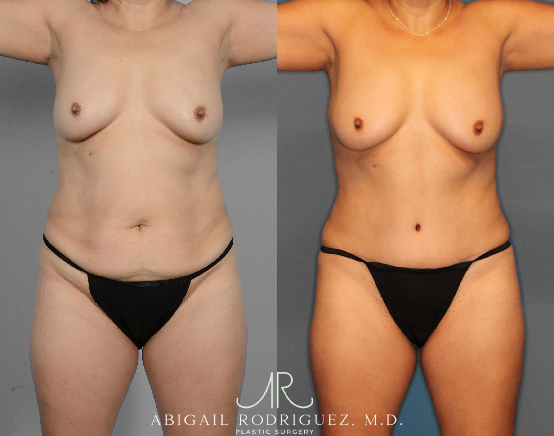 Before & After Tummy Tuck Case 254523 View 1 View in Houston, TX