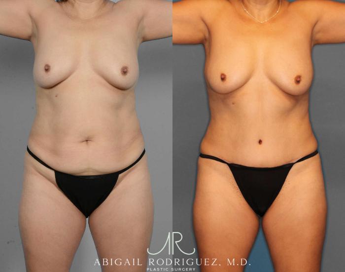 Before & After Tummy Tuck Case 254523 View 1 View in Houston, TX