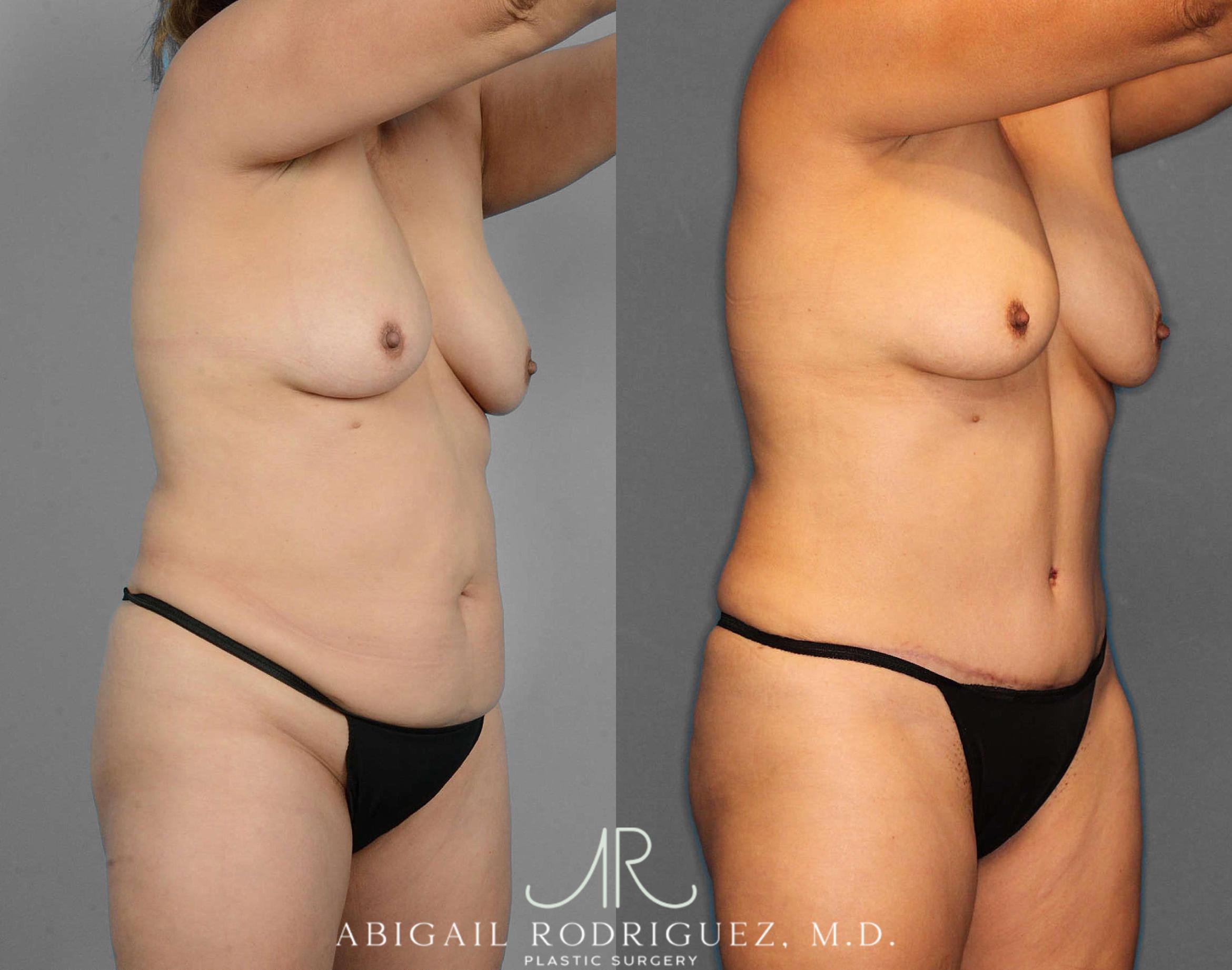 Before & After Tummy Tuck Case 254523 View 2 View in Houston, TX