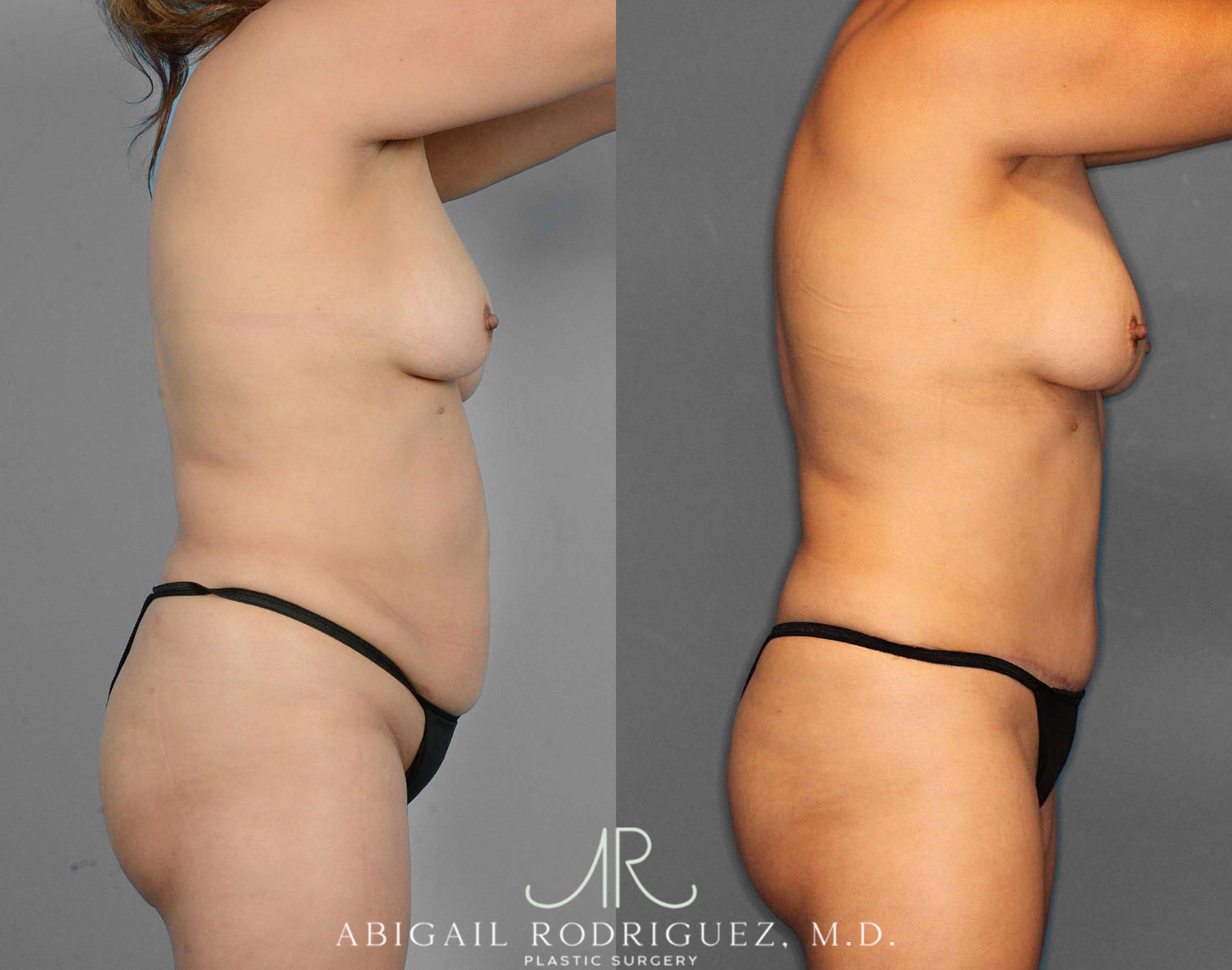 Before & After Tummy Tuck Case 254523 View 3 View in Houston, TX