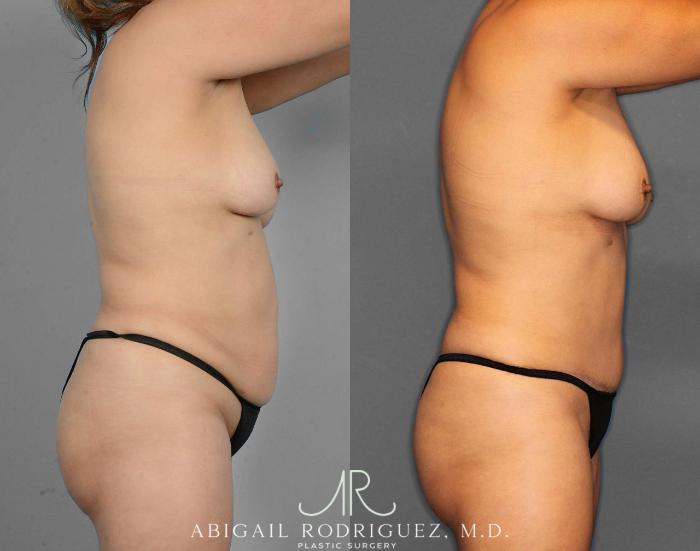 Before & After Tummy Tuck Case 254523 View 3 View in Houston, TX