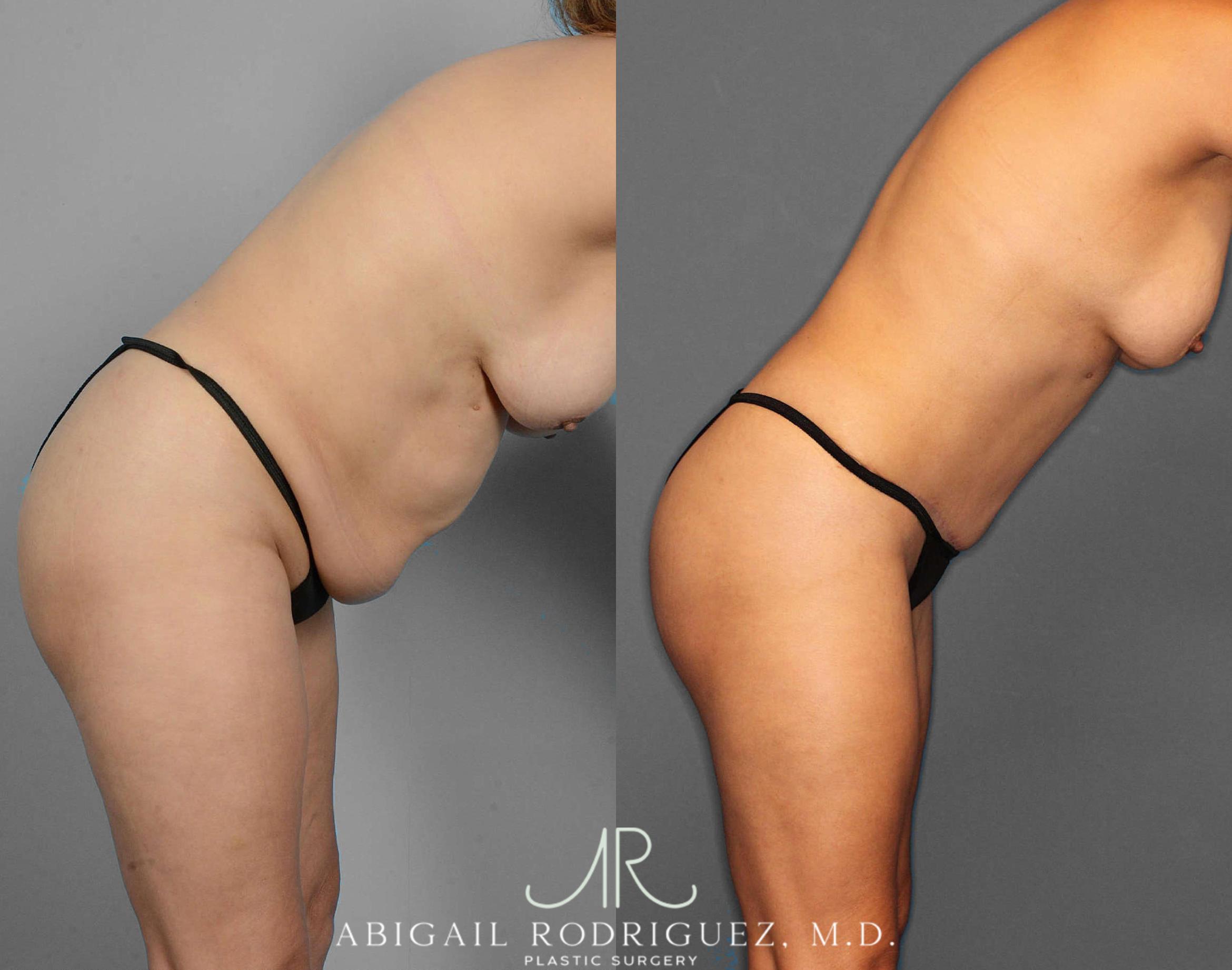 Before & After Tummy Tuck Case 254523 View 4 View in Houston, TX