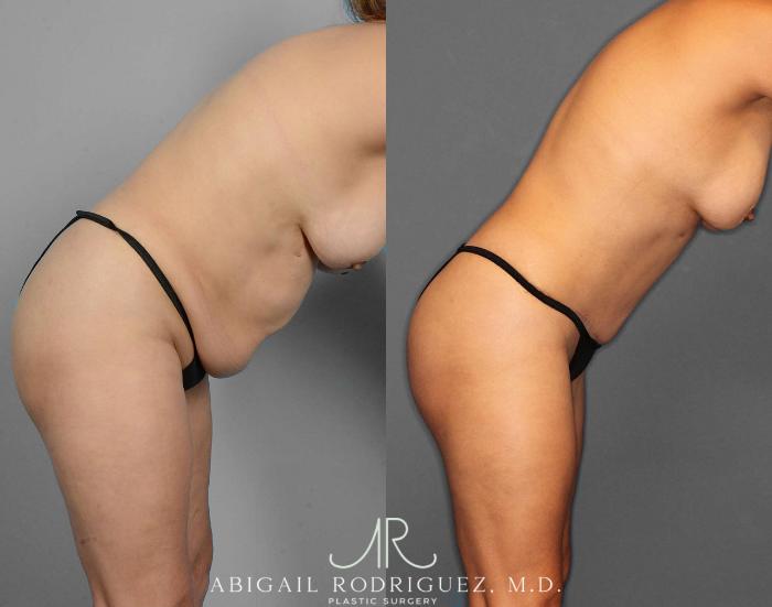 Before & After Tummy Tuck Case 254523 View 4 View in Houston, TX