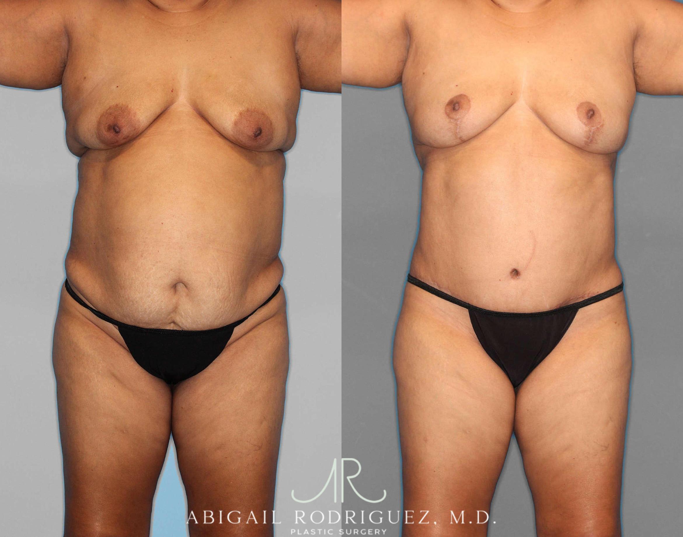 Before & After Tummy Tuck Case 254549 View 1 View in Houston, TX
