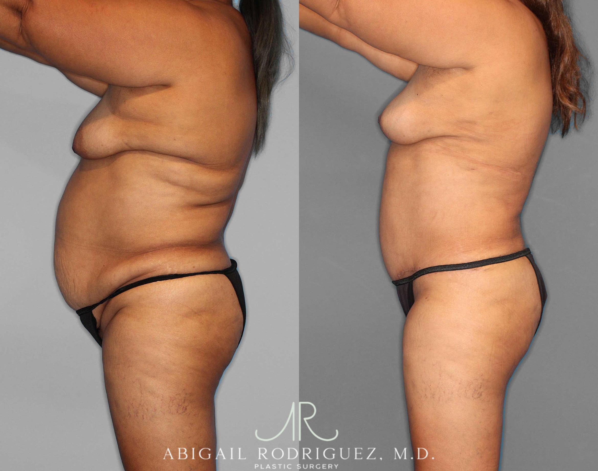 Before & After Tummy Tuck Case 254549 View 2 View in Houston, TX