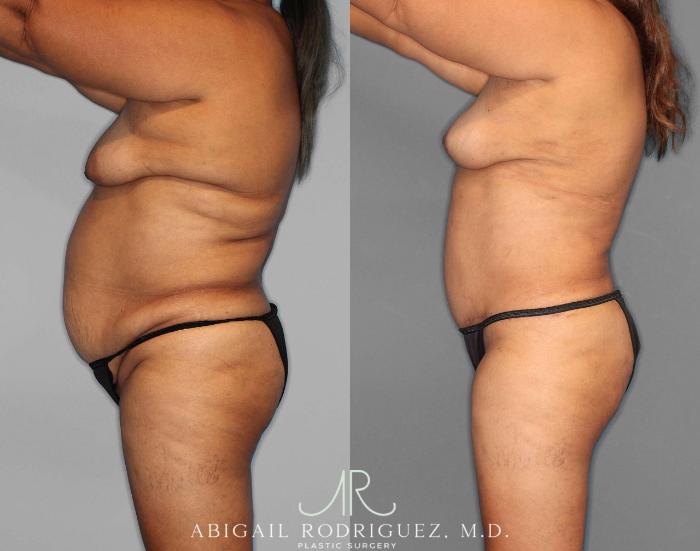 Before & After Tummy Tuck Case 254549 View 2 View in Houston, TX