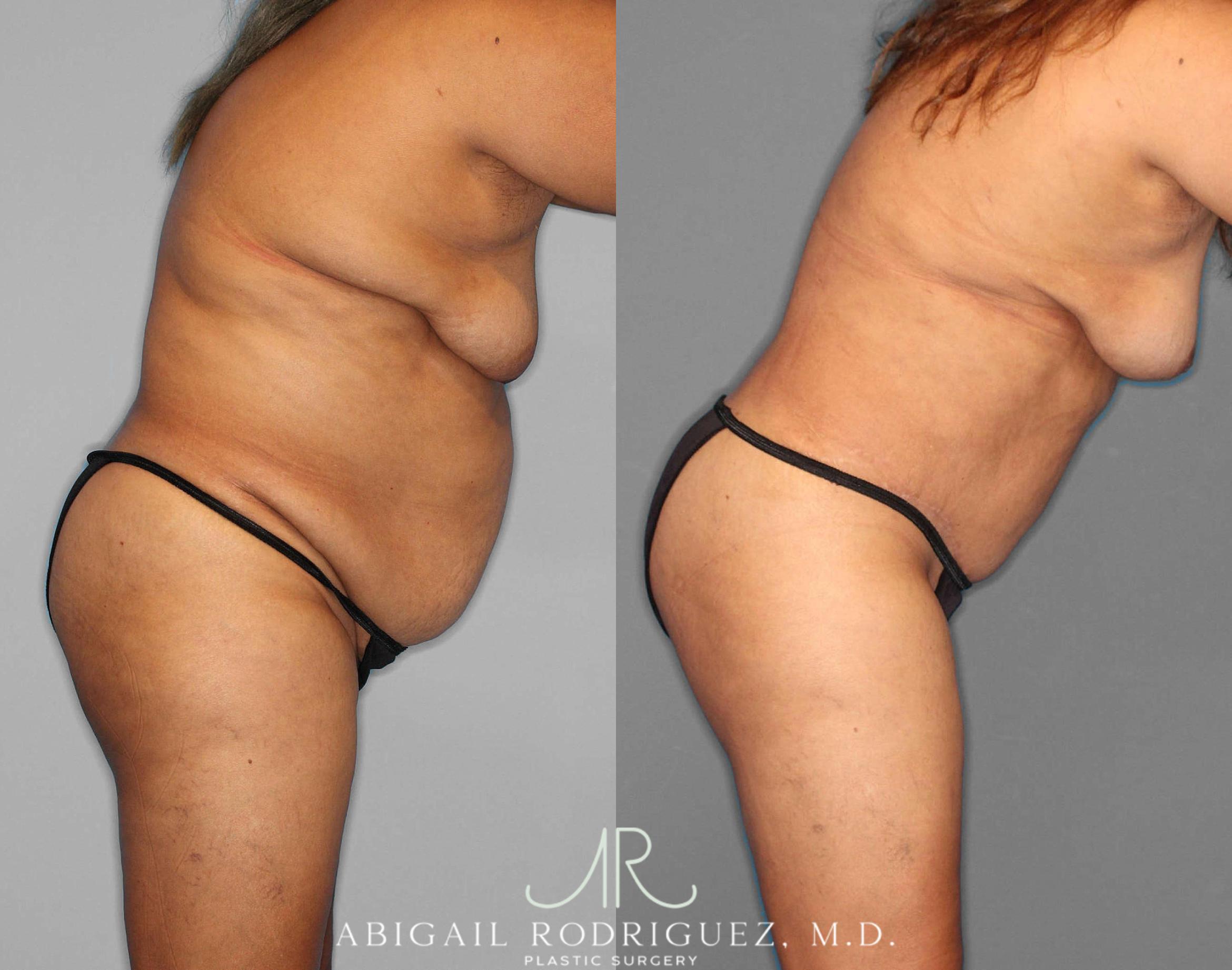 Before & After Tummy Tuck Case 254549 View 3 View in Houston, TX