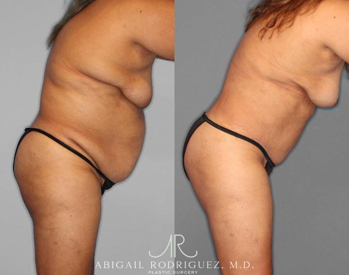 Before & After Tummy Tuck Case 254549 View 3 View in Houston, TX