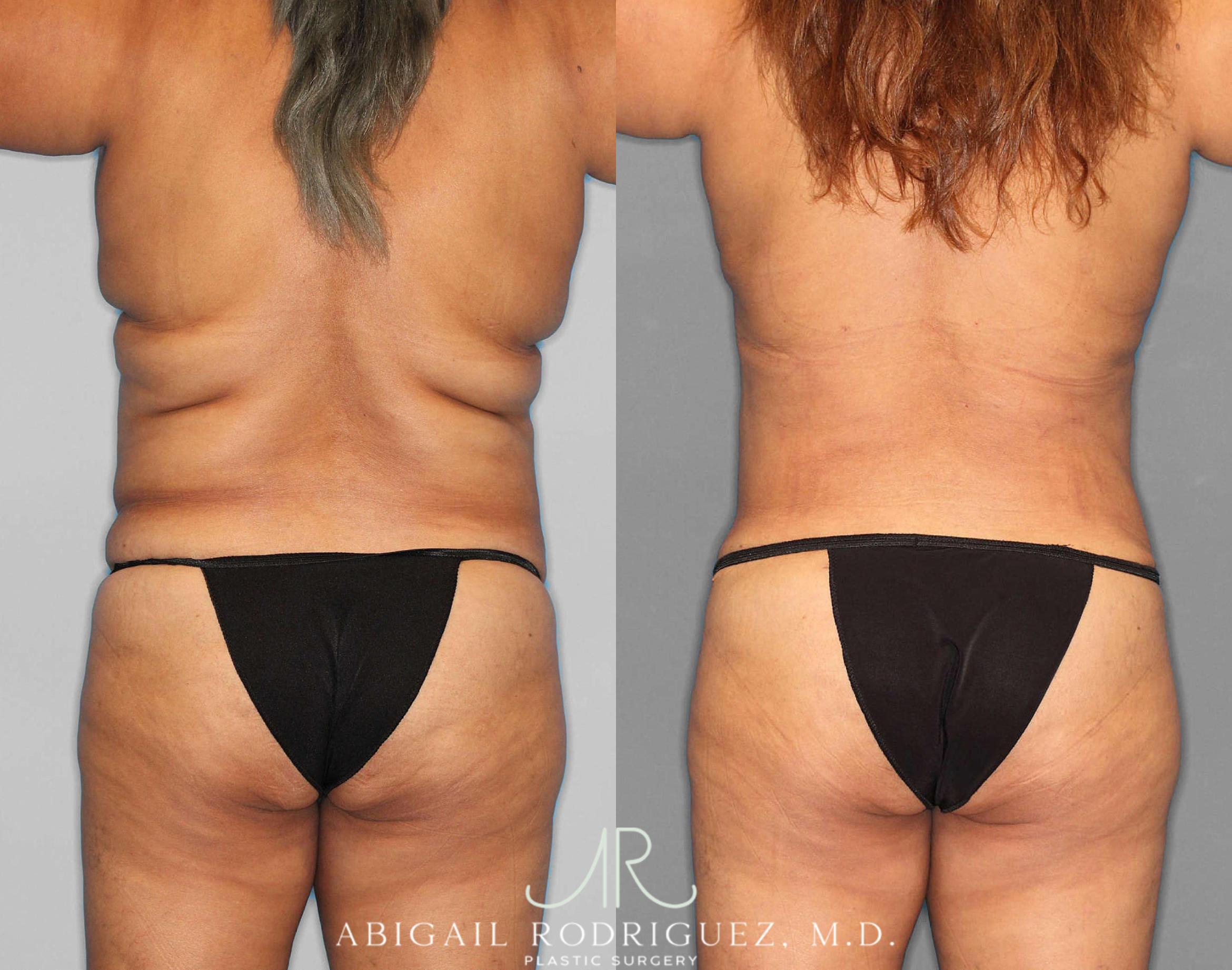 Before & After Tummy Tuck Case 254549 View 4 View in Houston, TX