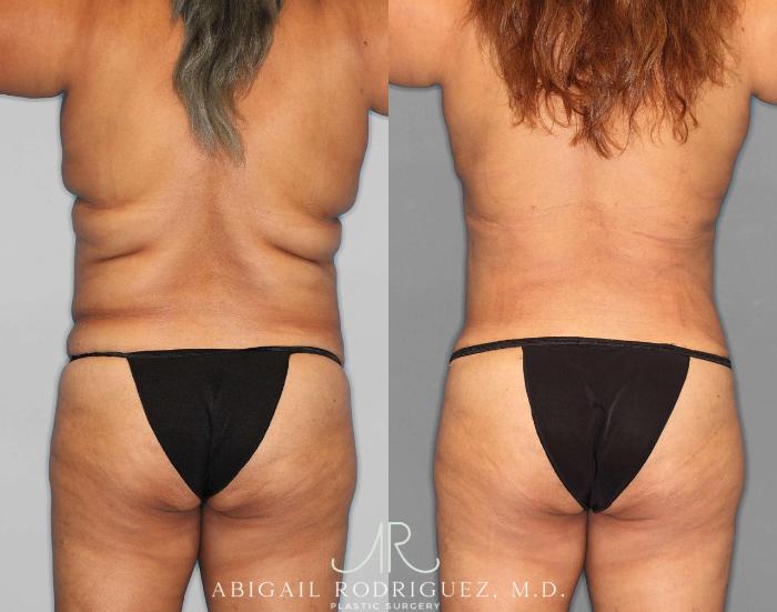 Before & After Tummy Tuck Case 254549 View 4 View in Houston, TX
