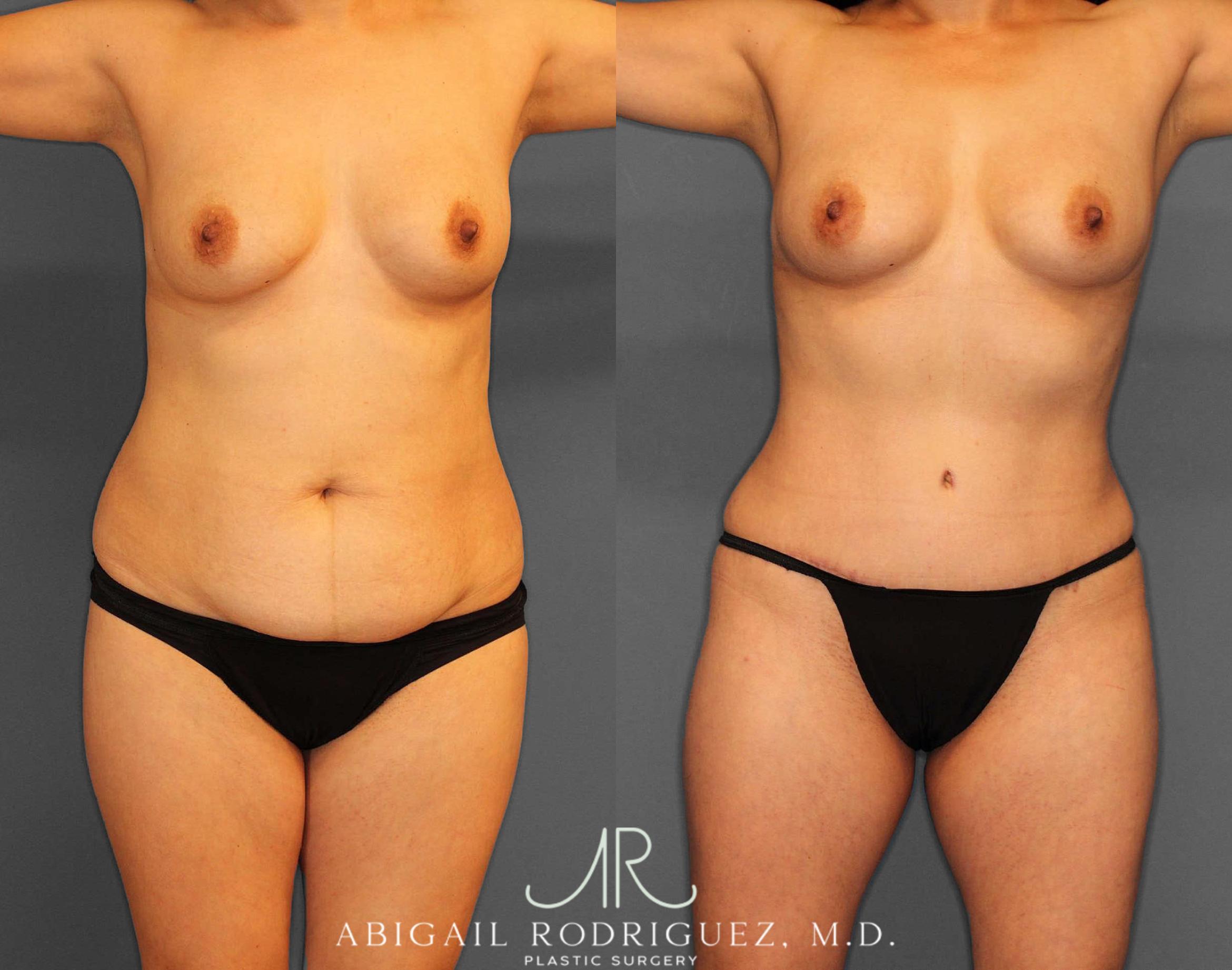Before & After Tummy Tuck Case 254809 View 1 View in Houston, TX