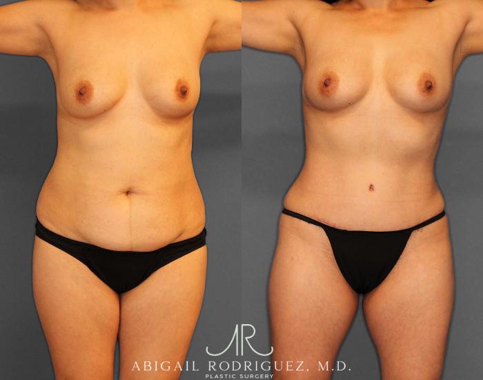 Before & After Tummy Tuck Case 254809 View 1 View in Houston, TX