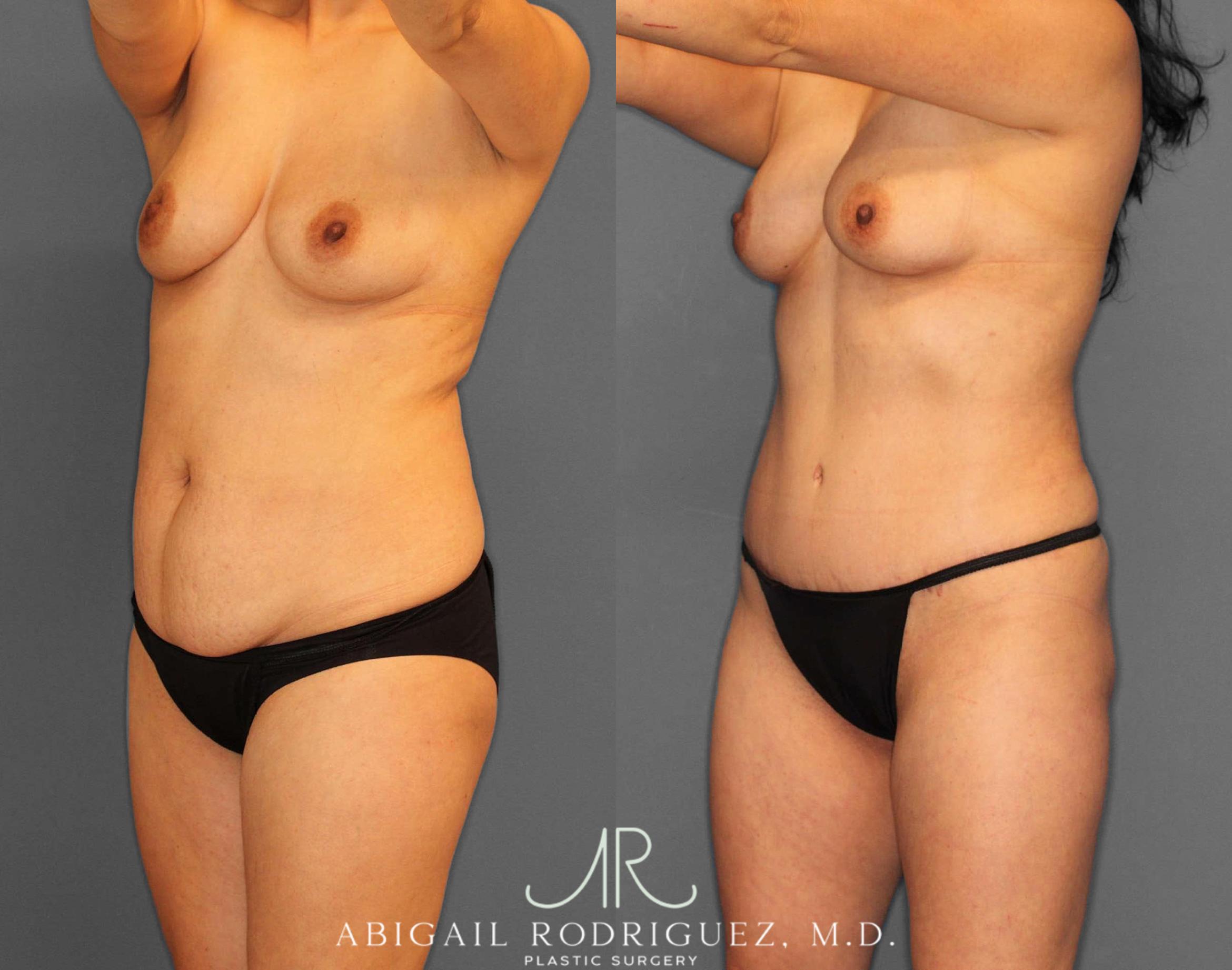 Before & After Tummy Tuck Case 254809 View 2 View in Houston, TX